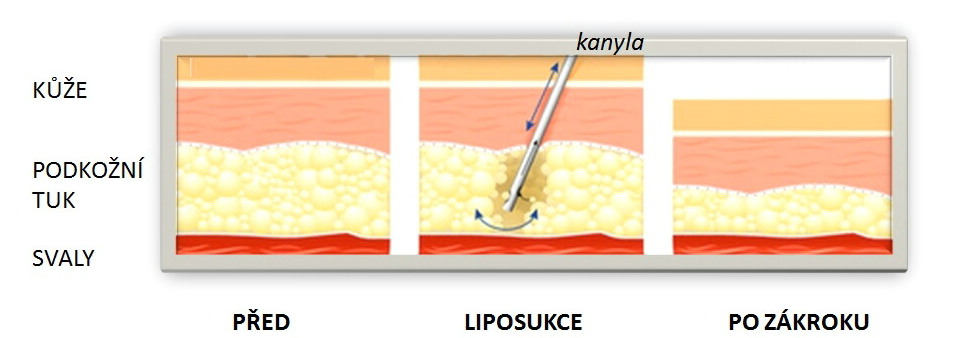schématický nákres podkožního tuku, liposukční kanyla, nákres stavu po liposukci